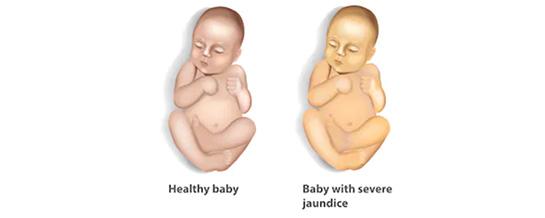 Jaundice in babies: What parents need to know