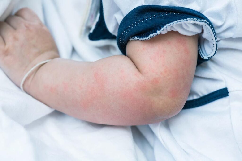 Hives (Urticaria) in children